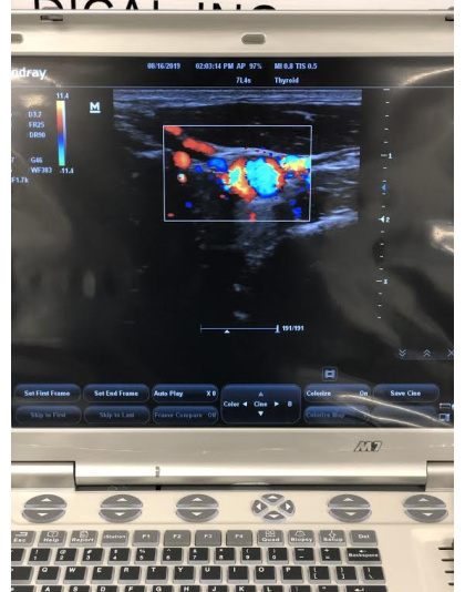 mindray 7l4s linear array probe sale