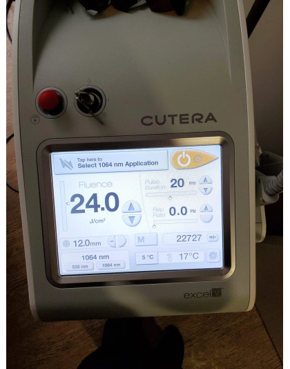 cutera excel v 2013 sale